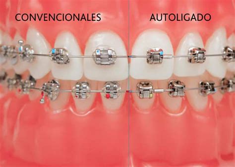 bracket estetico y metalico|bracket autoligado vs convencional.